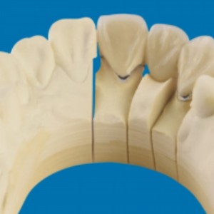 Métal-dents en porcelaine