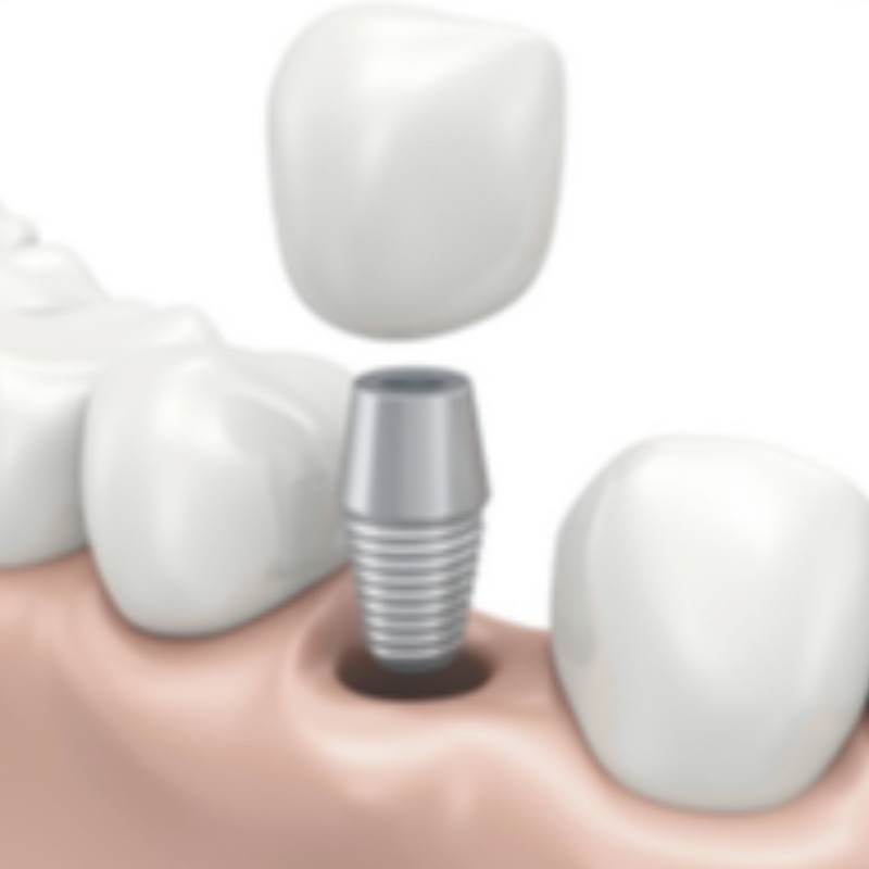 implant dentaire